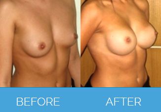 Breast Enlargement Procedure Before and After