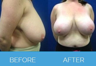 Breast Uplift Before and After - Mammoplasty