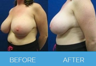 Breast-Reduction2