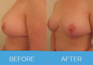 Breast Uplift Surgery Before and After