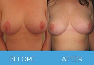 Breast Uplift Procedure - Before and After