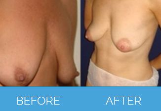 Breast Uplift