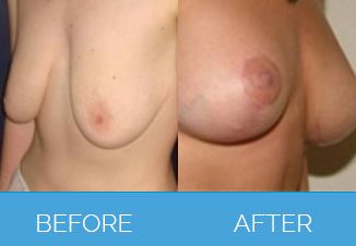 Breast Uplift
