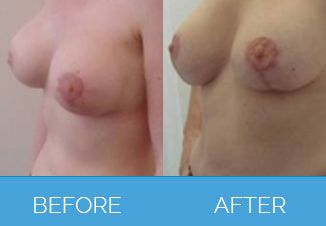 Breast Uplift