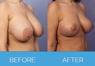 Breast Uplift