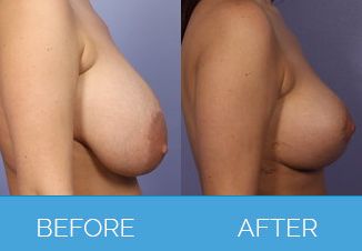 Breast Uplift