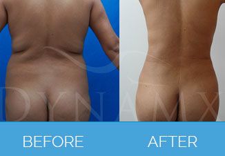 4D Vaser Liposuction1