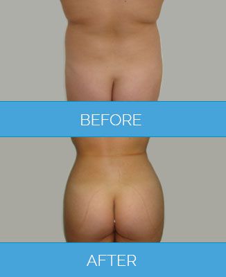 Radio Frequency Body Contouring treatment before after