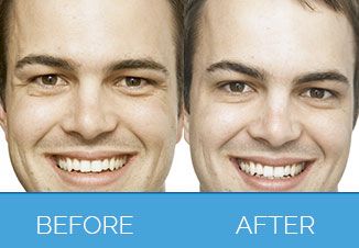 Before and After Male Dermal Fillers