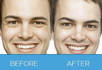 Dermal-Filler01