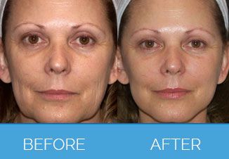Silhouette Facelift before & after