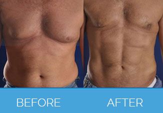 Male Vaser Liposuction | Liposuction for Men
