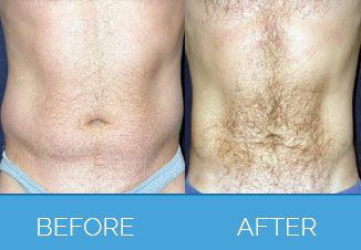 Male Vaser Liposuction | Liposuction for Men
