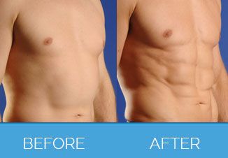 Male Vaser Liposuction | Liposuction for Men