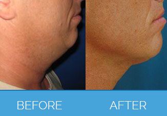 Male Vaser Liposuction | Liposuction for Men