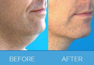 Vaser Liposuction before & after