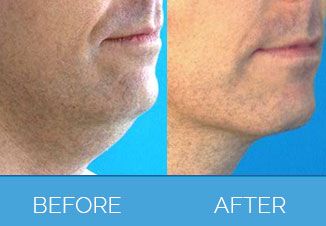 Male Vaser Liposuction | Liposuction for Men