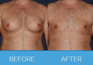 Male Vaser Liposuction | Liposuction for Men