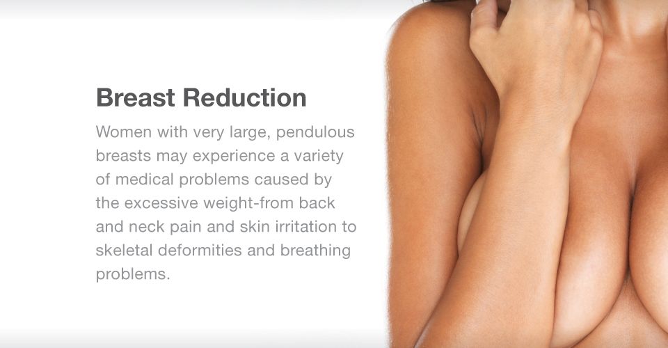 Breast-Reduction-Surgery