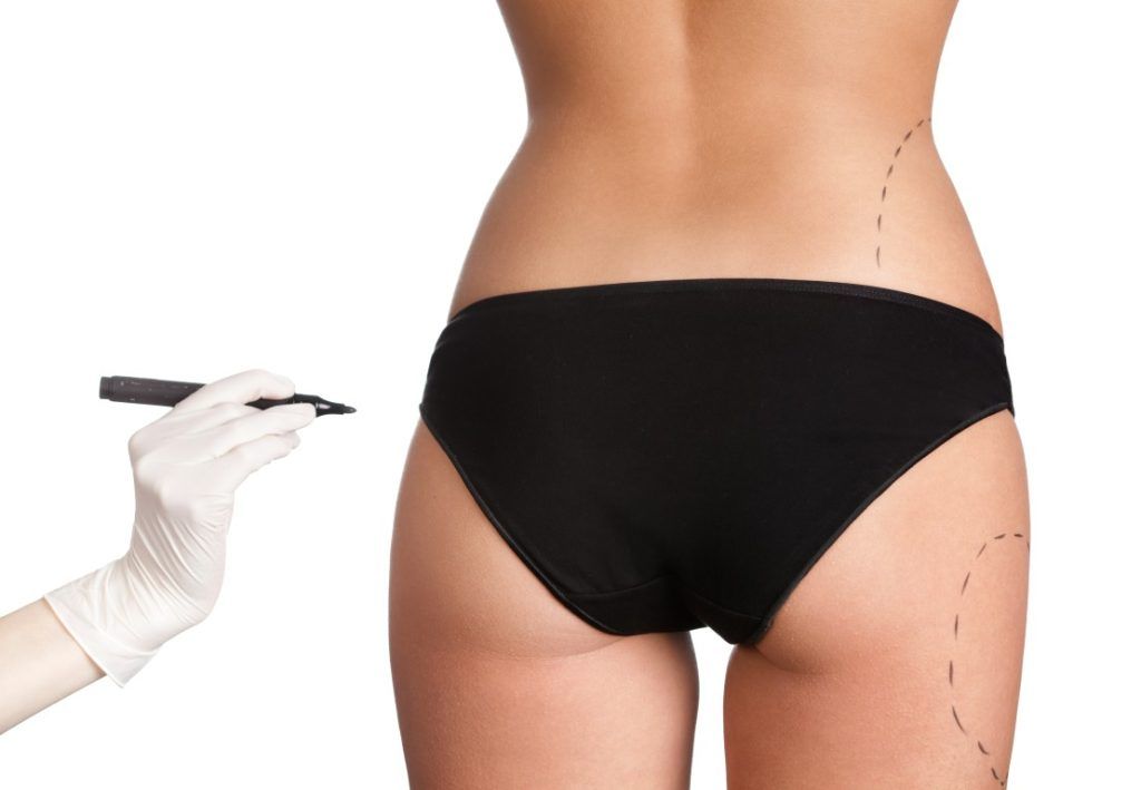 Buttock Augmentation