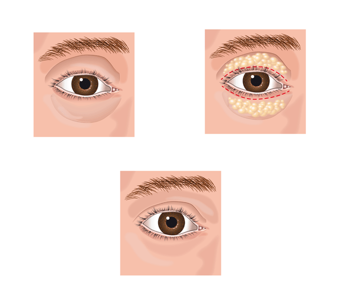 Eyebag-Surgery-Blepharoplasty