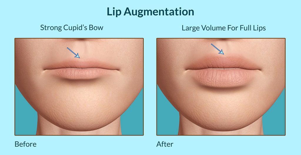 Lip-Augmentation before & after
