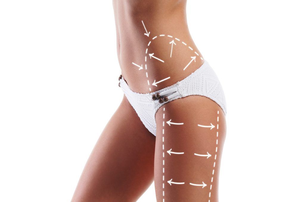 Liposuction treatment 