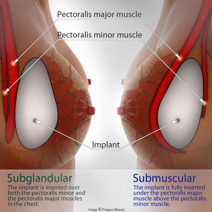 breast-augmentation