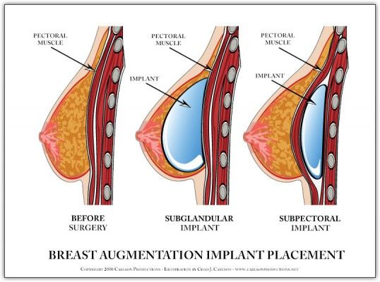 breast-implant-diagram1