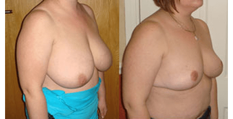 breast reduction and lift