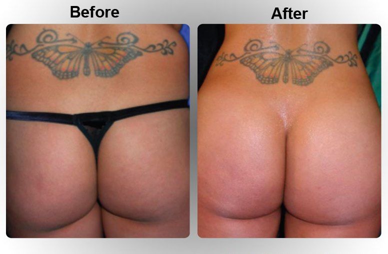 bum implant procedure