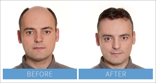 Hair Transplant