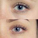Eye Bag Removal & Eyelid Surgery (Blepharoplasty) in London UK