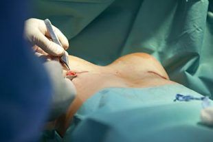 breast enlargement surgery