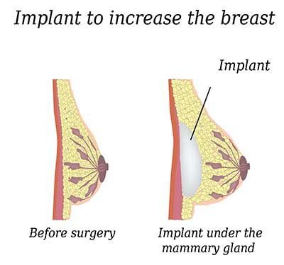 Breast Implant Replacement