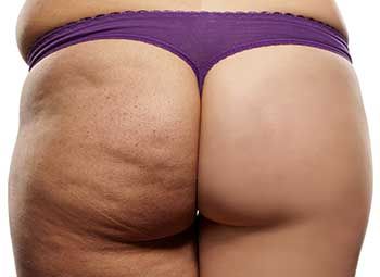Buttock Lift Surgery