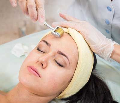 Dermaroller Treatment