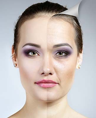 facelift