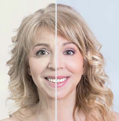 facelift recovery