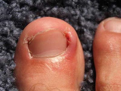 Ingrowing toenails