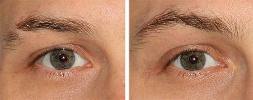 Eyebrow Transplantation | Eyebrow Transplantation UK | Nu Cosmetic Clinic