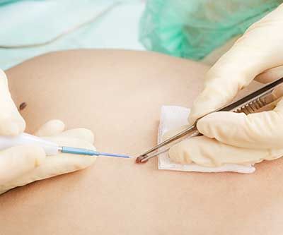 Mole/Skin Tag Removal Surgery
