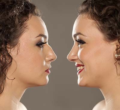 Nose Correction Before-After
