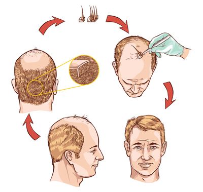 Hair Transplant | FUT Hair Transplant Birmingham | Hair Transplant Hair Transplant | FUT Hair Transplant Birmingham | Hair Transplant
