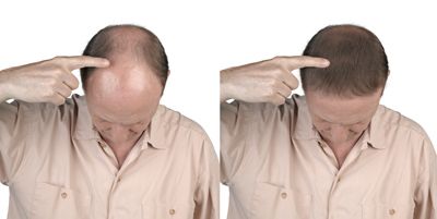 Hair Transplant result