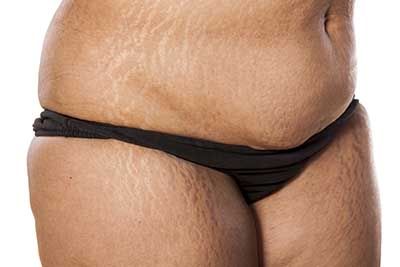 Stretch Mark Removal, Stretch Mark Treatment, Price, Process, Clinic in UK Stretch Mark Removal, Stretch Mark Treatment, Price, Process, Clinic in UK