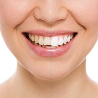Teeth Whitening Laser Teeth Whitening | Laser Teeth Whitening UK | Nu Cosmetic Clinic