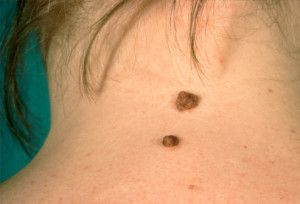 Mole-Removal