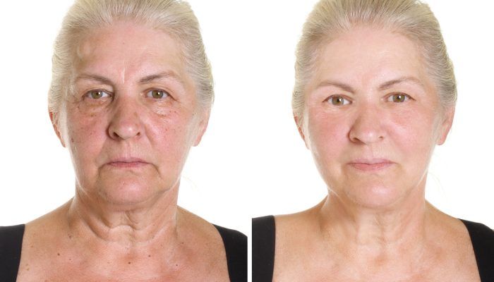 Skin Tags - Before and After
