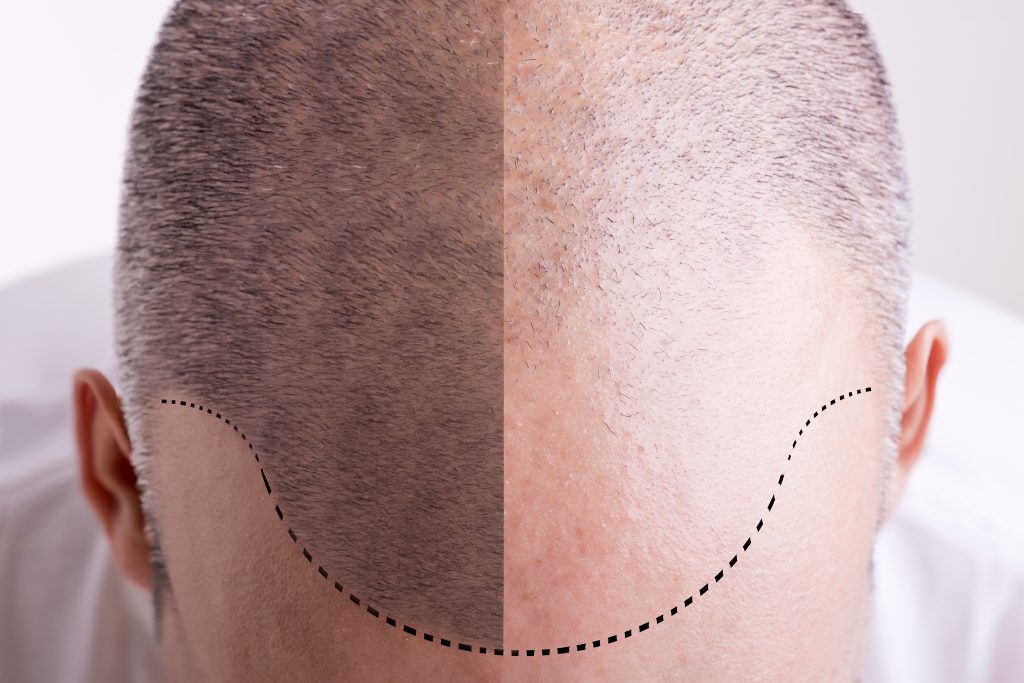 hair transplantation
